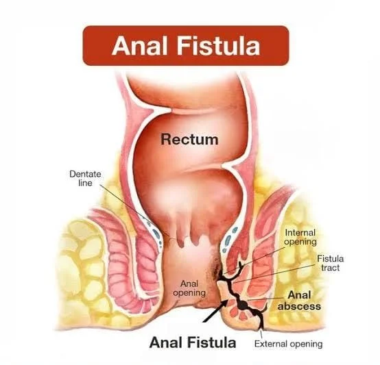 Anal Fistula Surgery