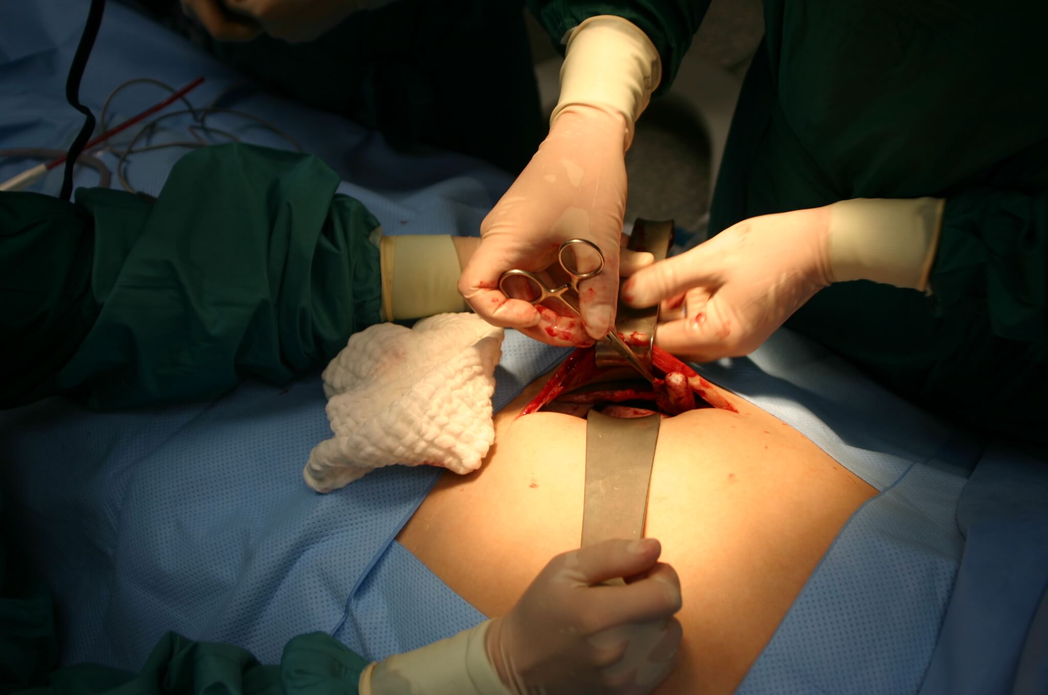 Appendectomy Surgery