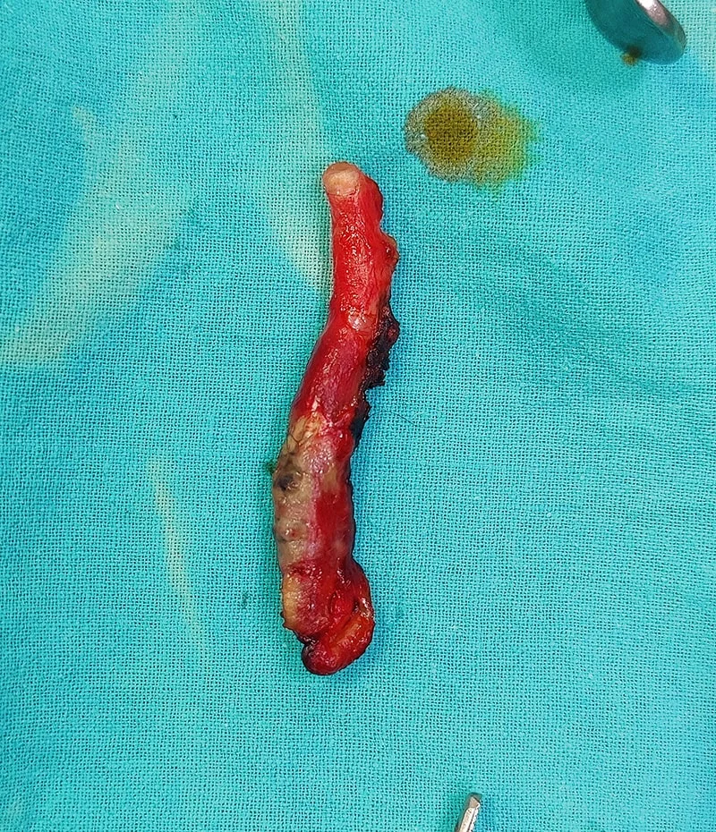 Appendectomy Surgery