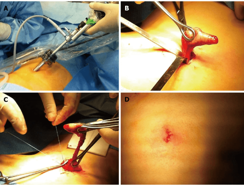 Appendectomy Surgery