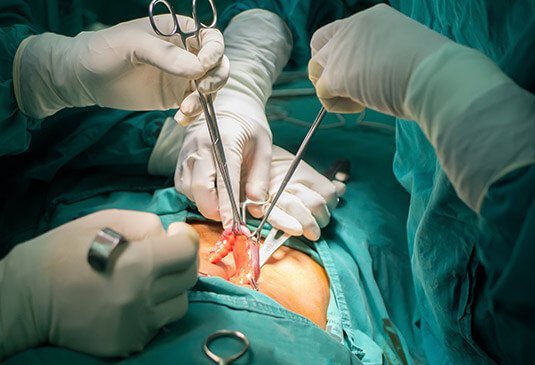 Appendectomy (Appendix Removal)