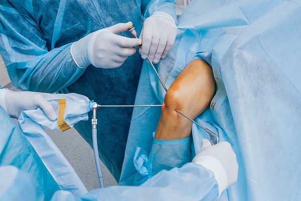 Arthroscopic Knee Surgery
