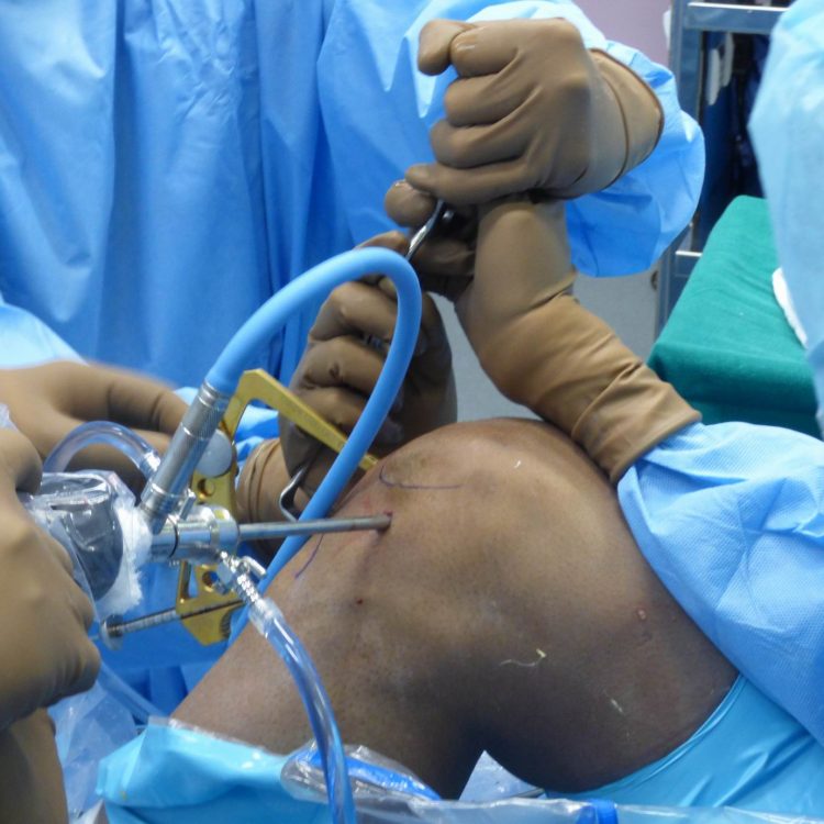Arthroscopic Knee Surgery