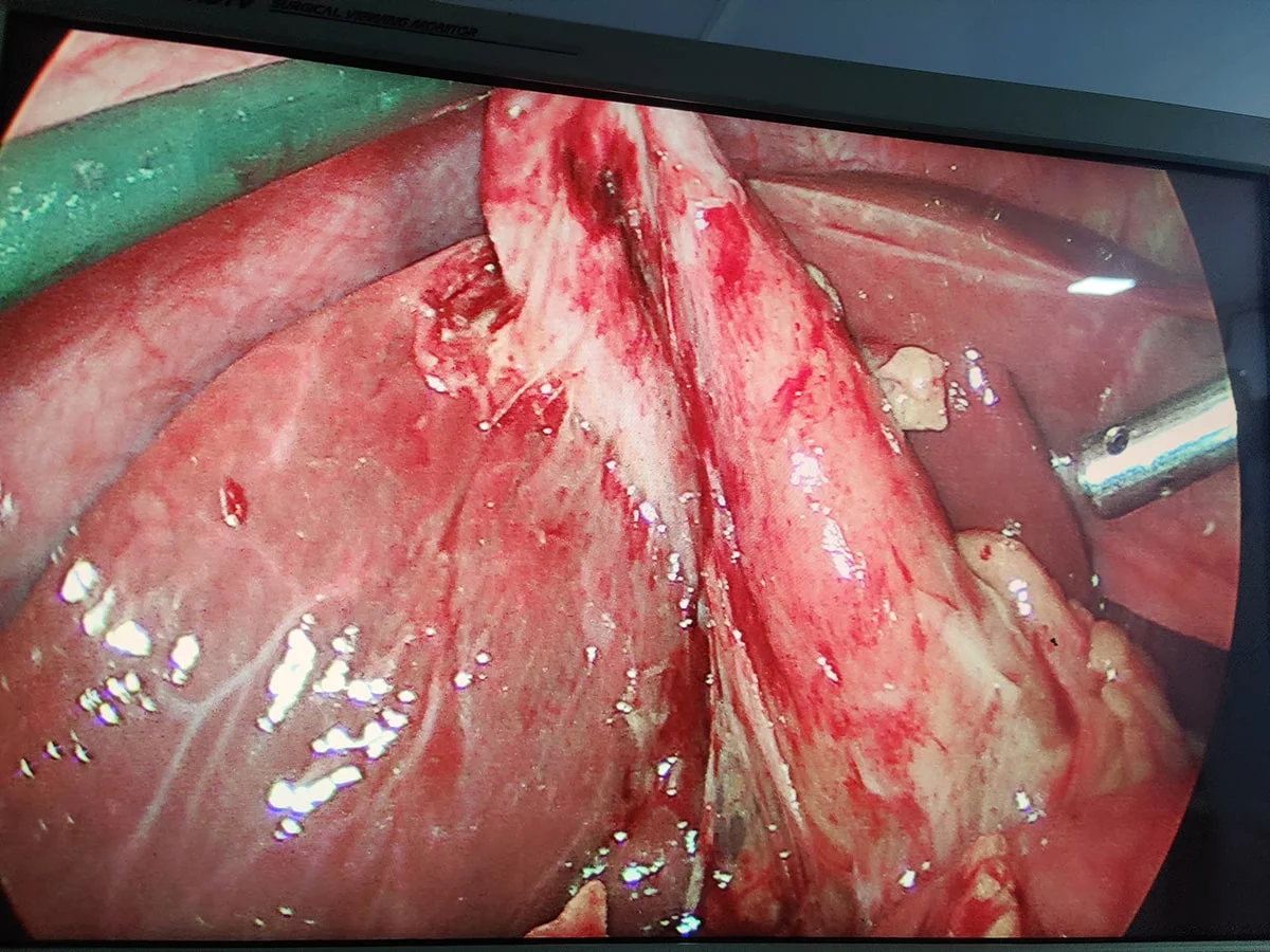 Cholecystectomy for Gallstones Surgery