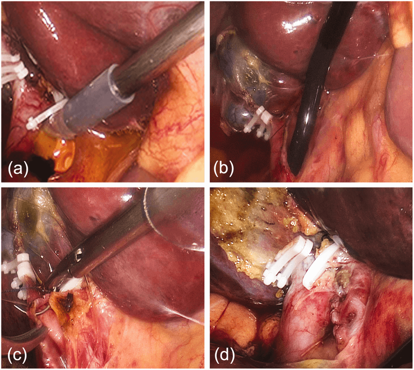 Cholecystectomy for Gallstones Surgery