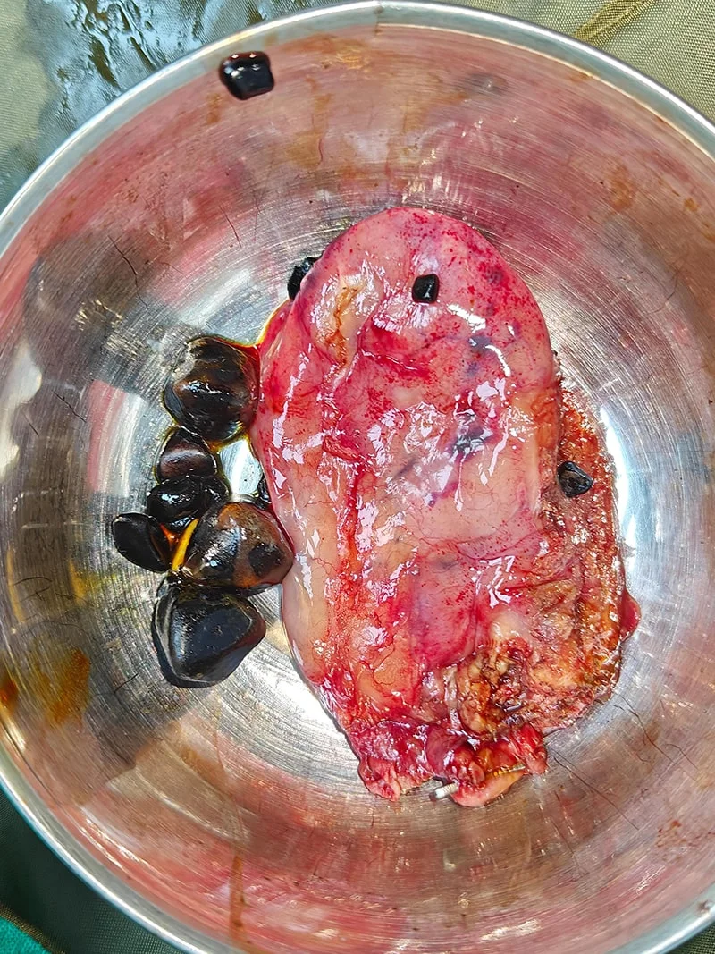 Cholecystectomy for Gallstones Surgery