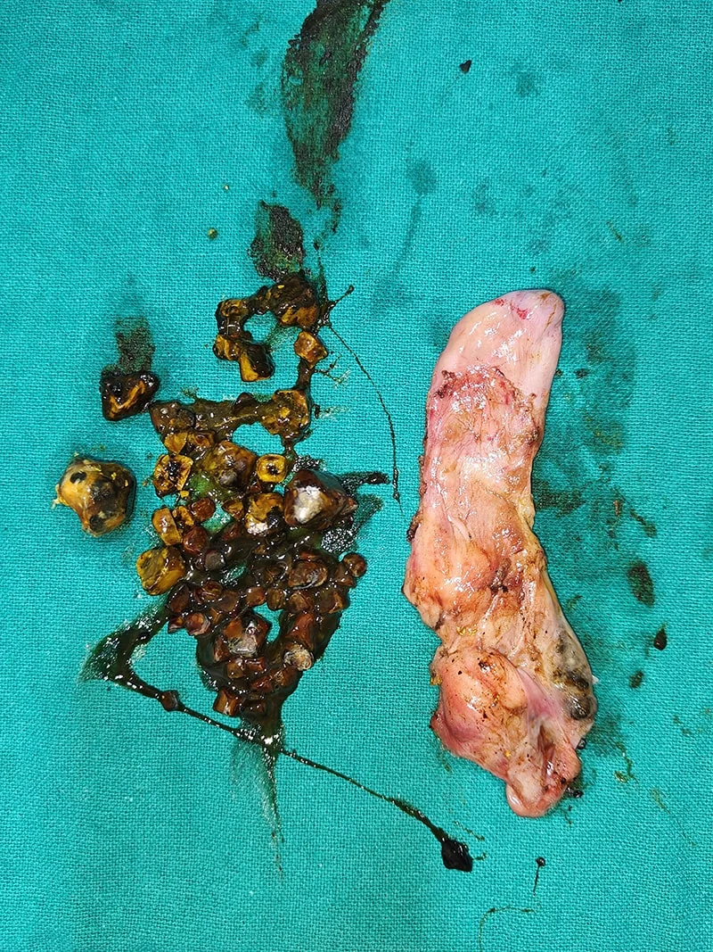 Cholecystectomy for Gallstones Surgery