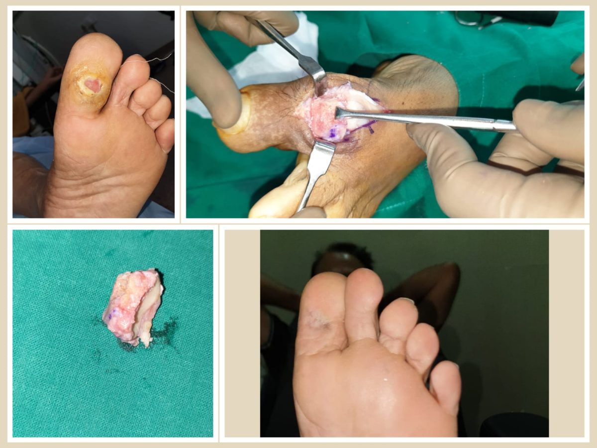 Diabetic Foot