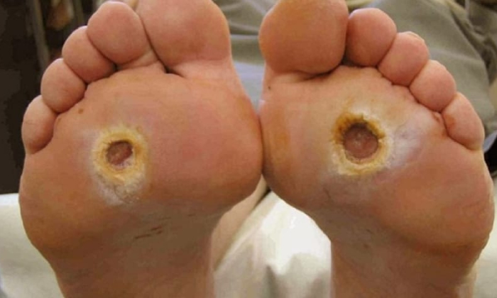Diabetic Foot