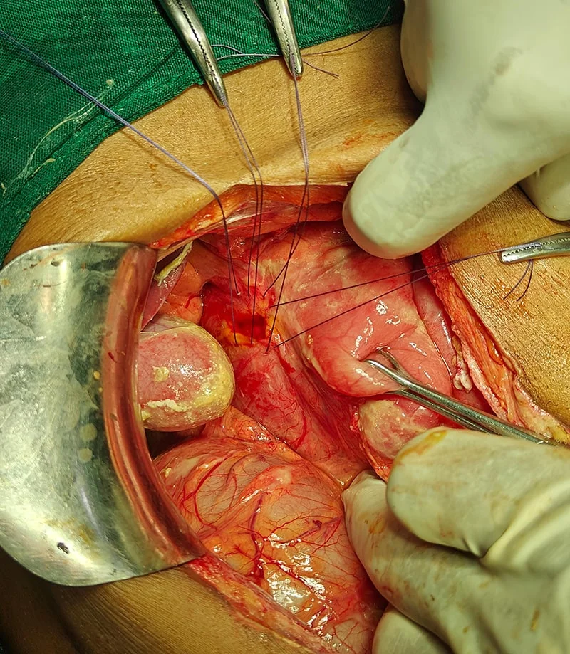 GI Surgeries