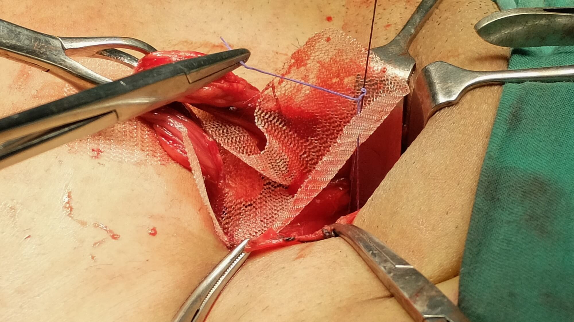 Hernia Surgery