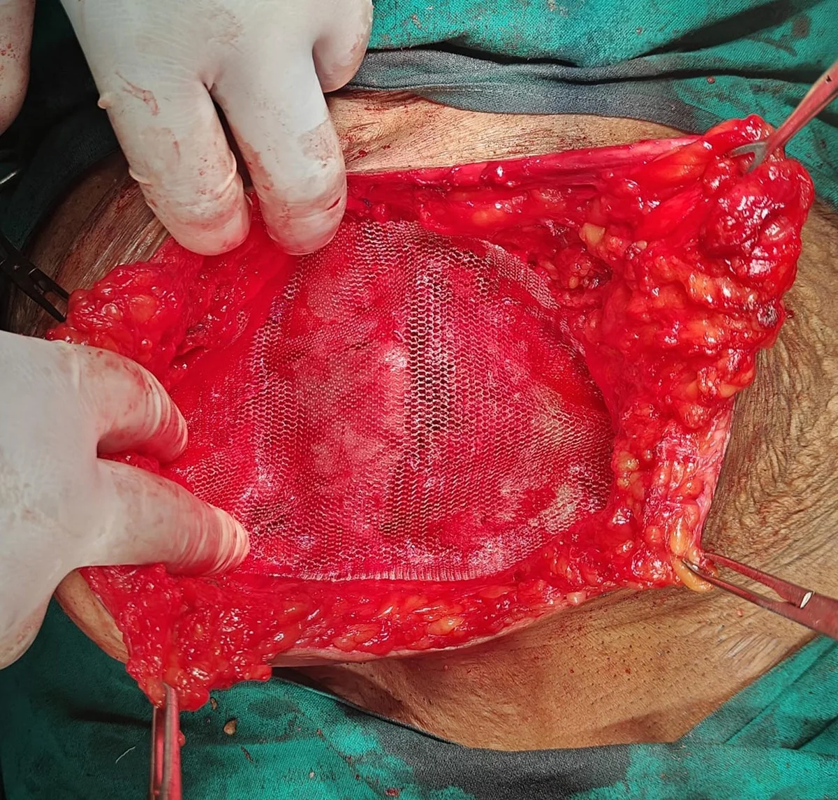 Hernia Surgery