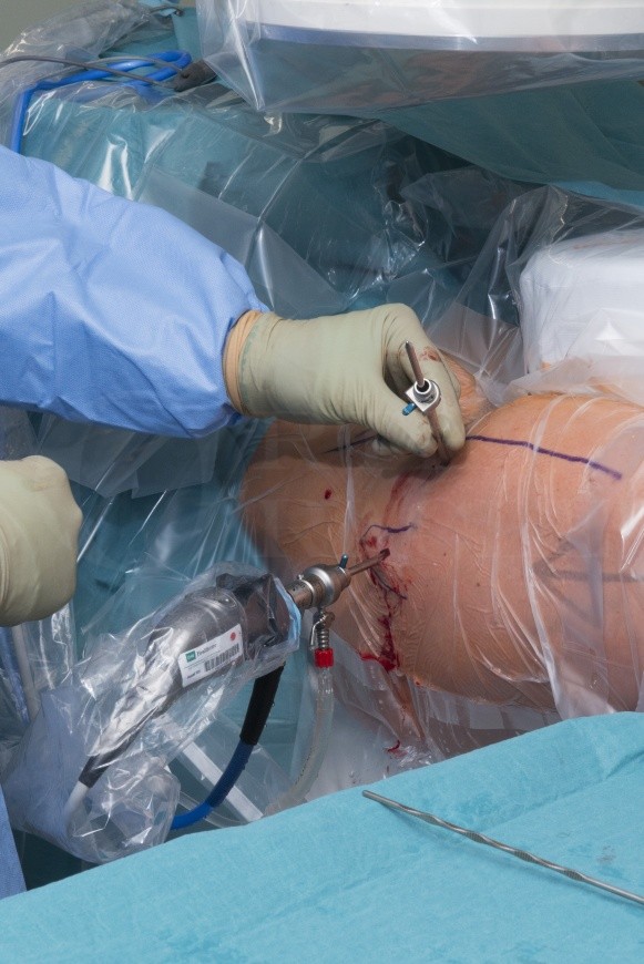 Hip Arthroscopy Surgery