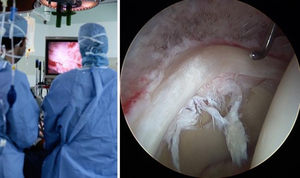 Hip Arthroscopy Surgery