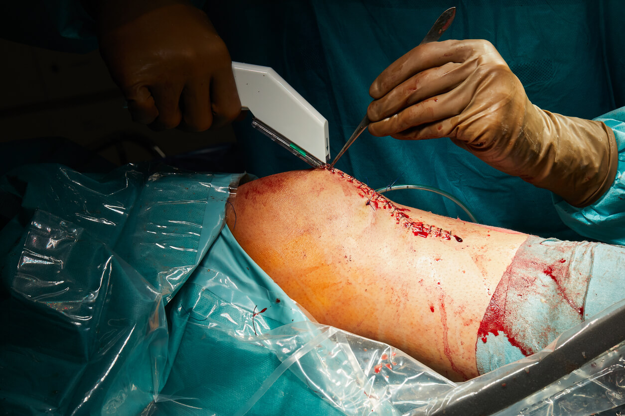 Anterior Cruciate Ligament