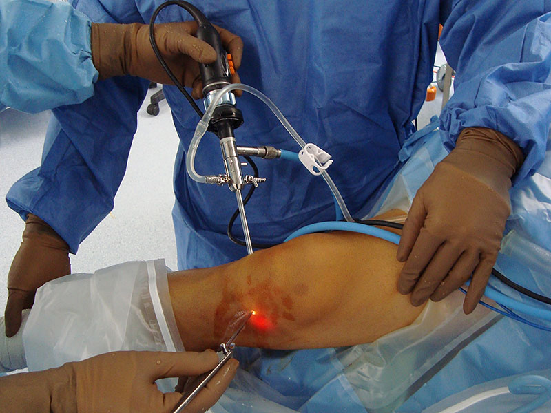 Knee Meniscus Tear Surgery