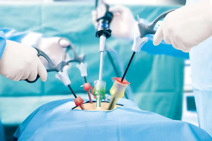Laparoscopy Surgery