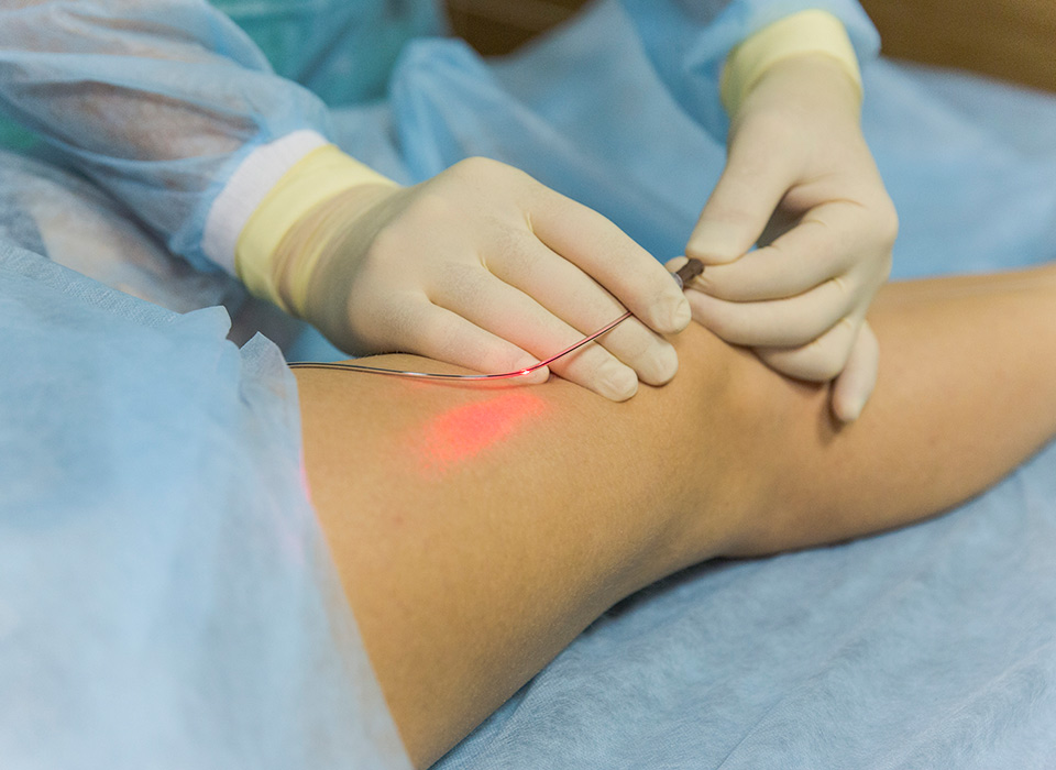 Laser Treatment
