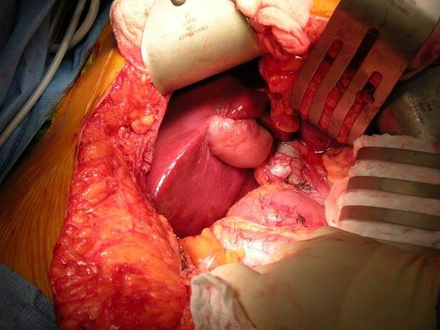 Cholecystectomy for Gallstones