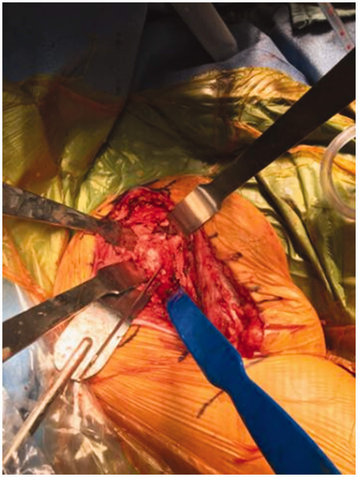 Reverse Shoulder Arthroplasty Surgery