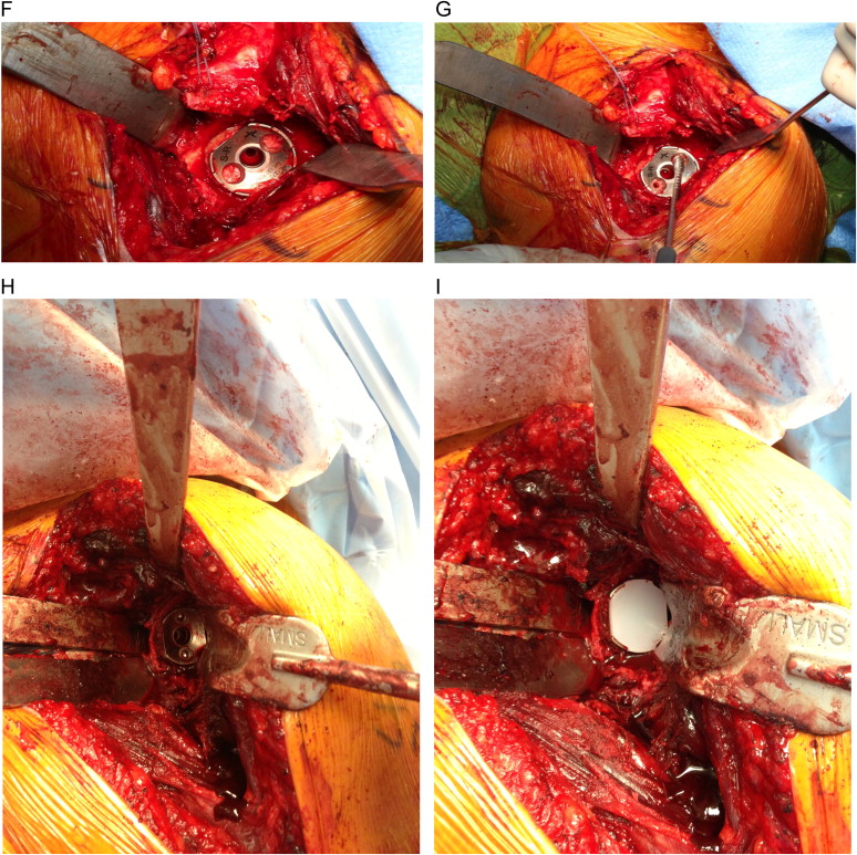 Reverse Shoulder Arthroplasty Surgery