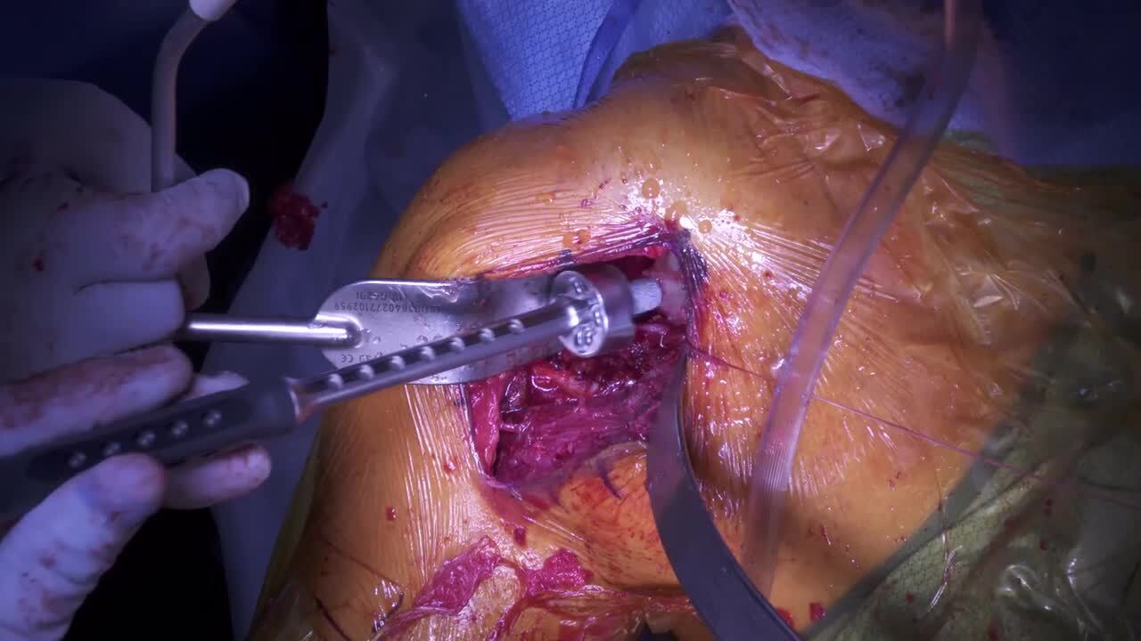 Reverse Shoulder Arthroplasty Surgery