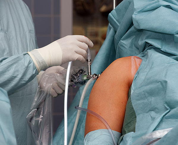 Shoulder Arthroscopy Surgery