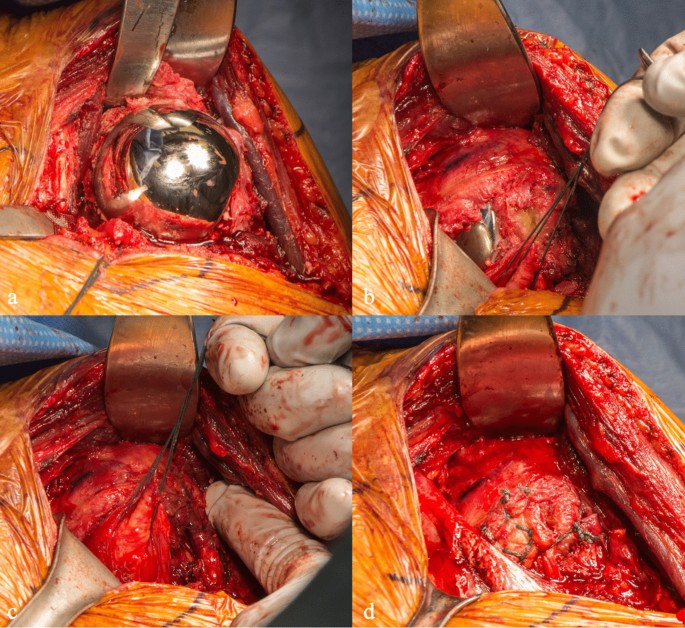 Shoulder Replacement Surgery