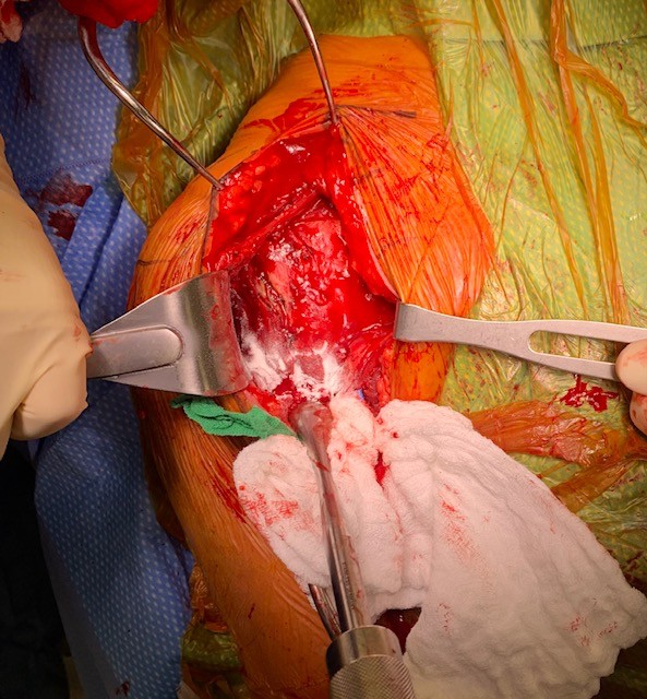 Shoulder Arthroscopy Surgery